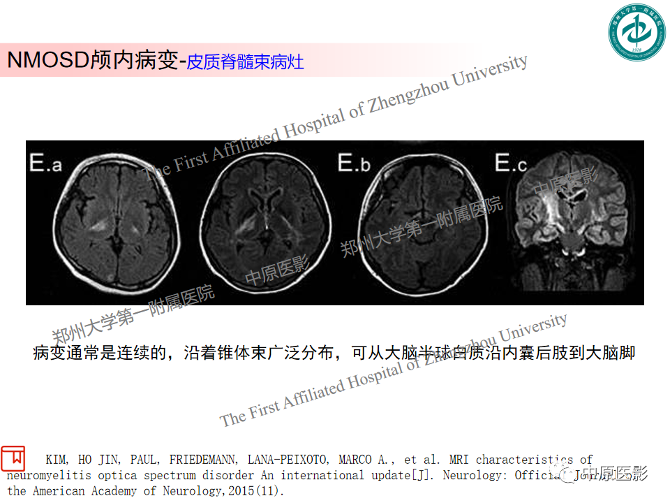 【PPT】视神经脊髓炎与多发性硬化鉴别诊断-13