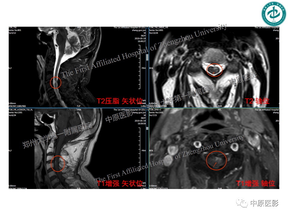 【PPT】视神经脊髓炎与多发性硬化鉴别诊断-52