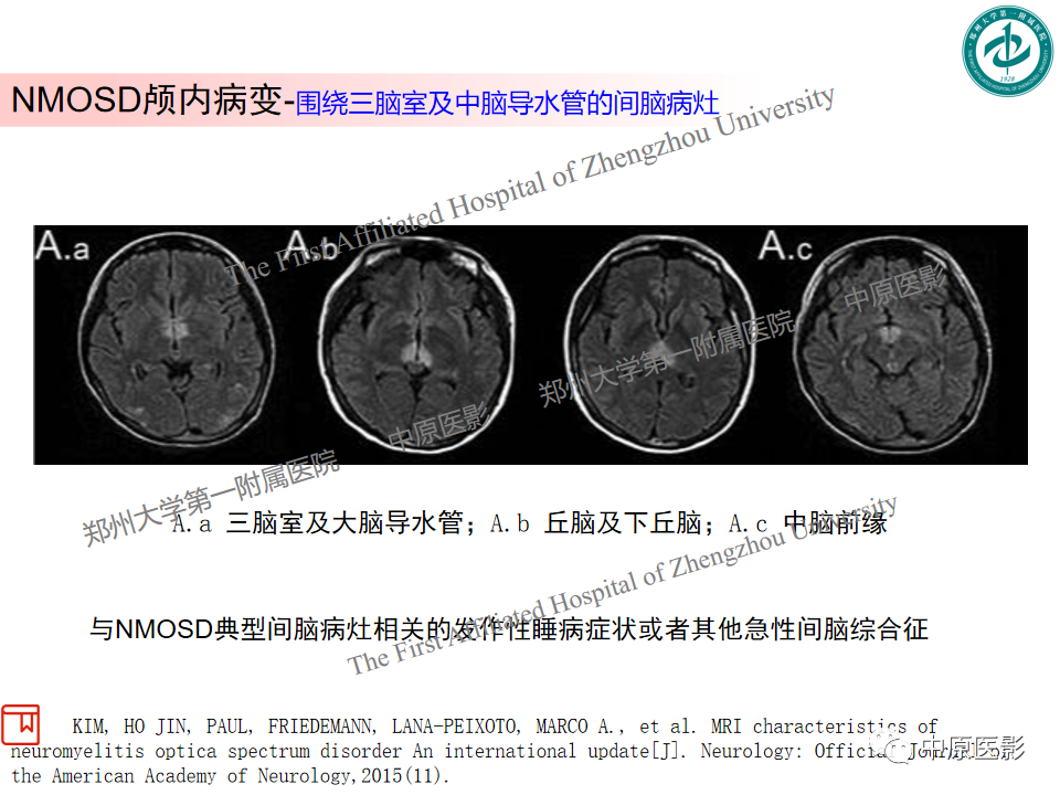 【PPT】视神经脊髓炎与多发性硬化鉴别诊断-9