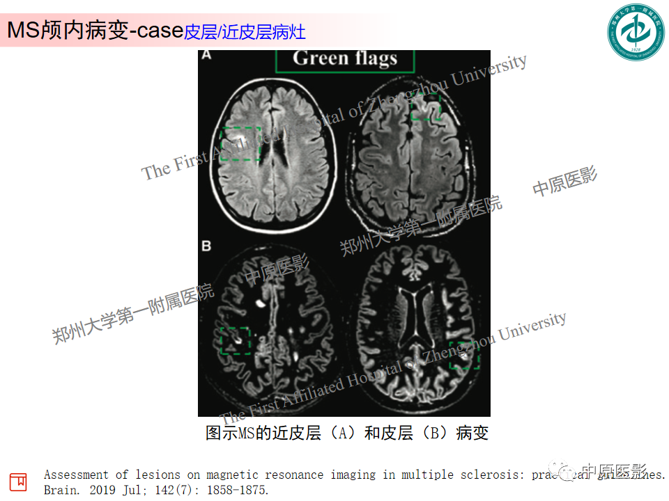 【PPT】视神经脊髓炎与多发性硬化鉴别诊断-33