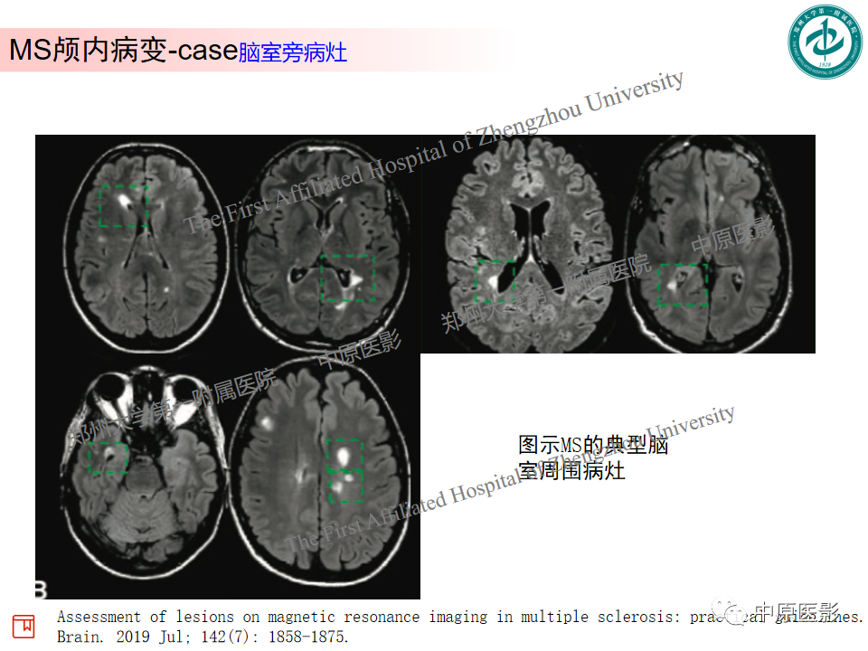 【PPT】视神经脊髓炎与多发性硬化鉴别诊断-34