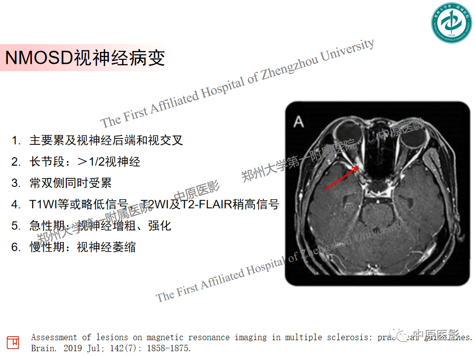 【PPT】视神经脊髓炎与多发性硬化鉴别诊断-7