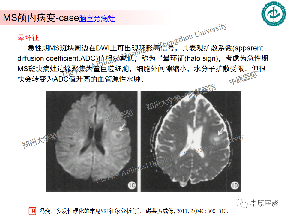 【PPT】视神经脊髓炎与多发性硬化鉴别诊断-38