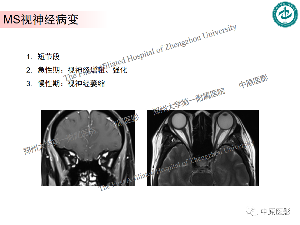 【PPT】视神经脊髓炎与多发性硬化鉴别诊断-29