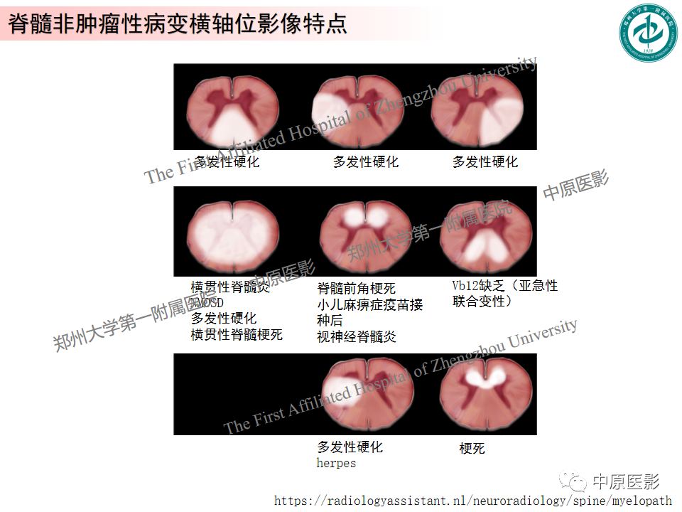 【PPT】视神经脊髓炎与多发性硬化鉴别诊断-45