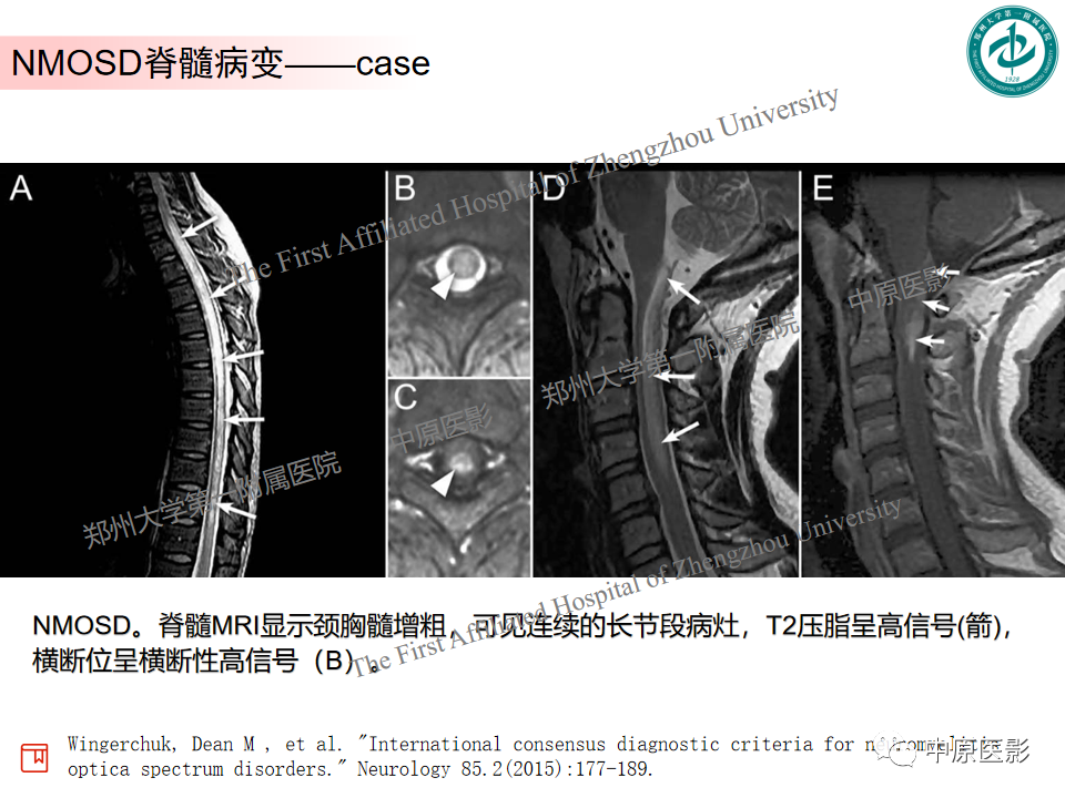 【PPT】视神经脊髓炎与多发性硬化鉴别诊断-6