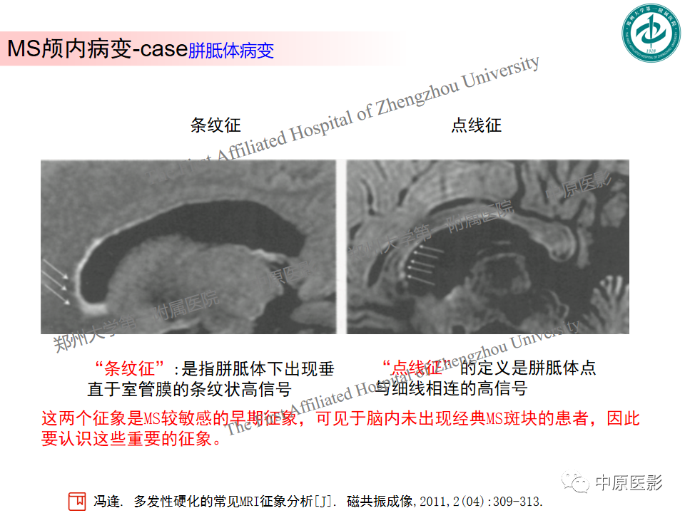 【PPT】视神经脊髓炎与多发性硬化鉴别诊断-41