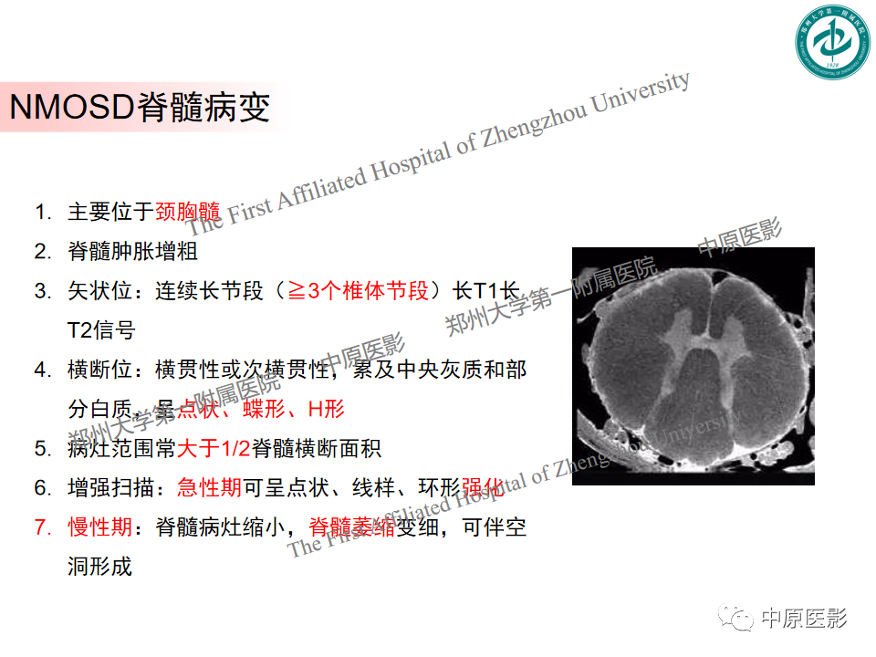 【PPT】视神经脊髓炎与多发性硬化鉴别诊断-5