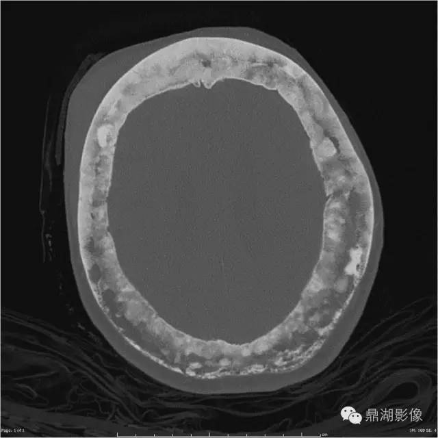 棉絮征—佩吉特骨病-5