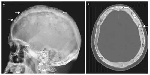 棉絮征—佩吉特骨病-2
