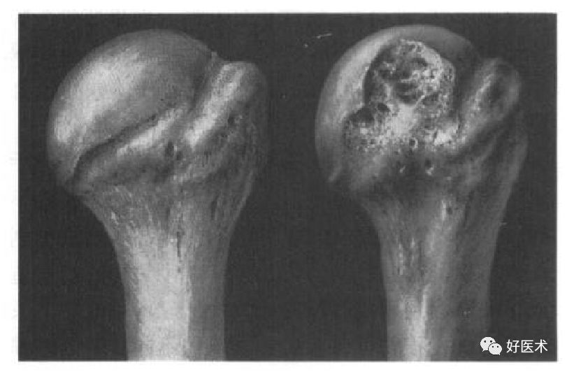 肩关节损伤的影像学诊断-56