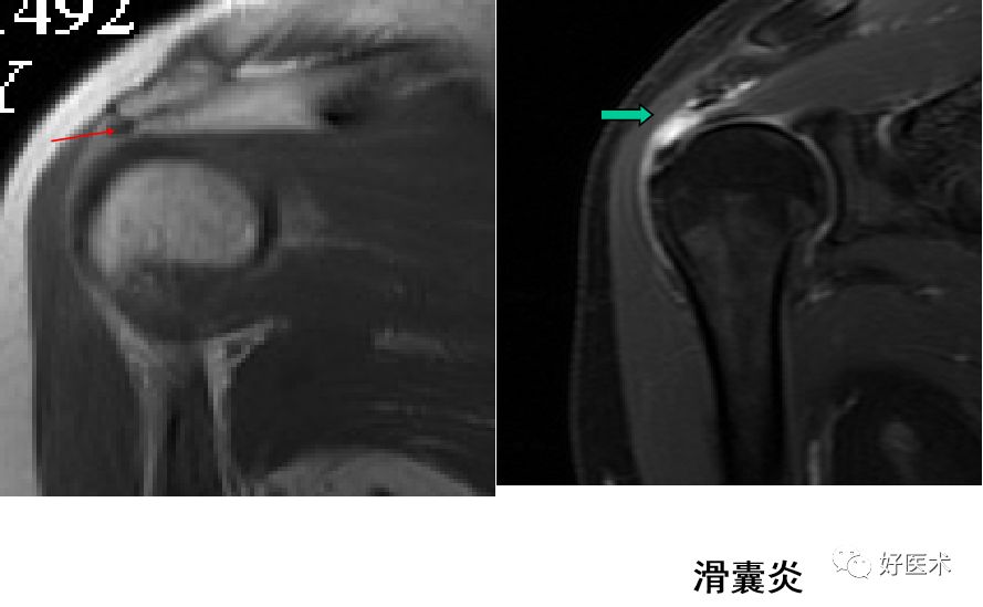 肩关节损伤的影像学诊断-30