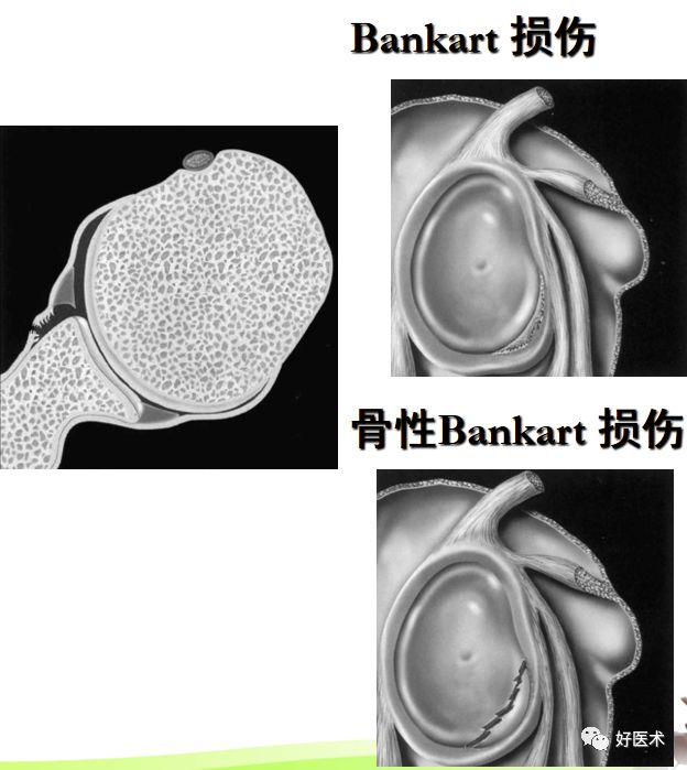肩关节损伤的影像学诊断-47