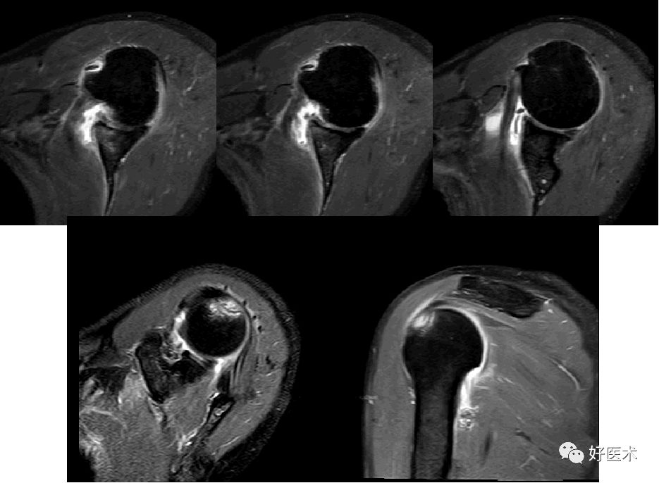 肩关节损伤的影像学诊断-59