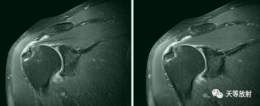 肩关节损伤的影像学诊断-45