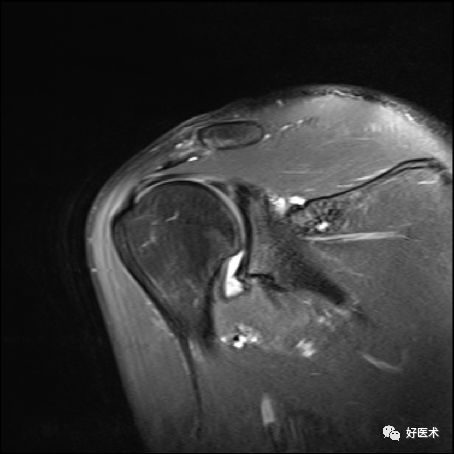 肩关节损伤的影像学诊断-51