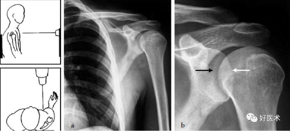 肩关节损伤的影像学诊断-11