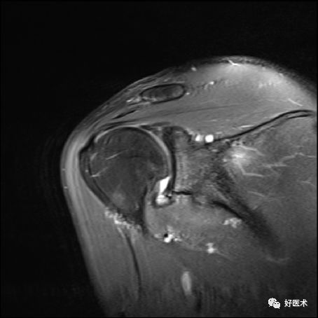 肩关节损伤的影像学诊断-52