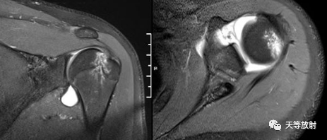 肩关节损伤的影像学诊断-48