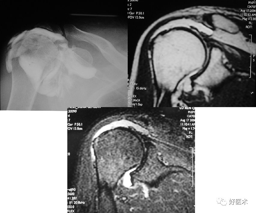 肩关节损伤的影像学诊断-21