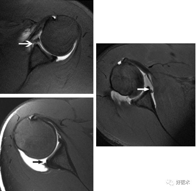 肩关节损伤的影像学诊断-28
