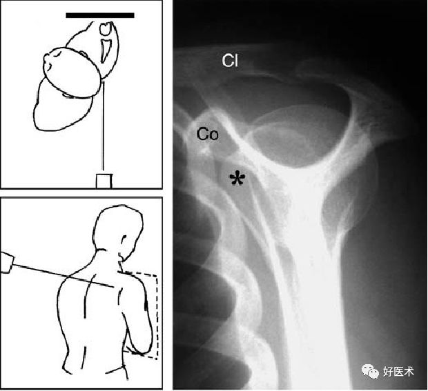肩关节损伤的影像学诊断-13