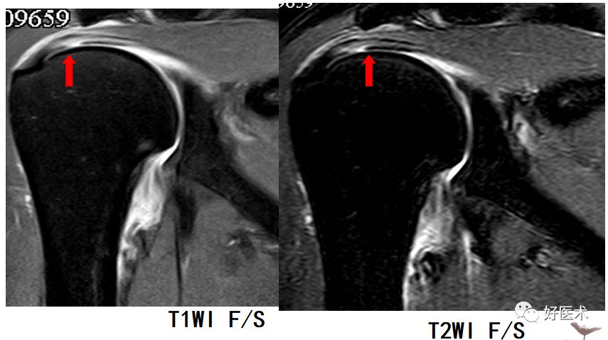 肩关节损伤的影像学诊断-32