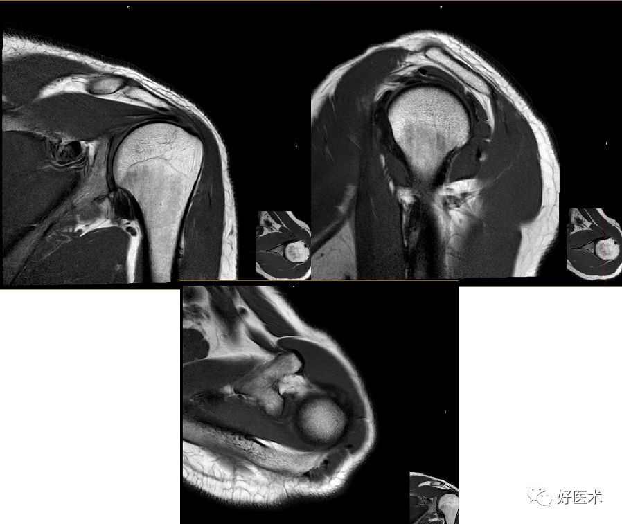 肩关节损伤的影像学诊断-29