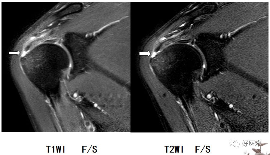 肩关节损伤的影像学诊断-36