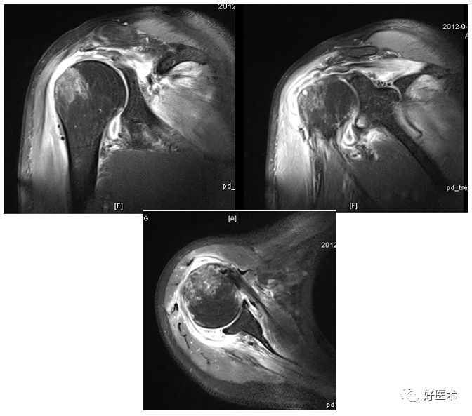 肩关节损伤的影像学诊断-39