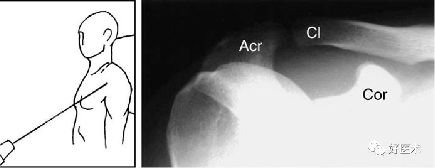 肩关节损伤的影像学诊断-18