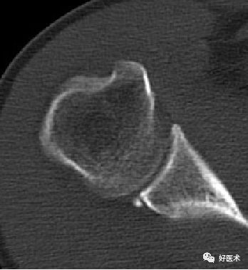 肩关节损伤的影像学诊断-23