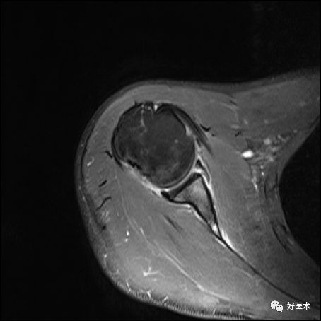 肩关节损伤的影像学诊断-54