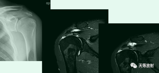 肩关节损伤的影像学诊断-35