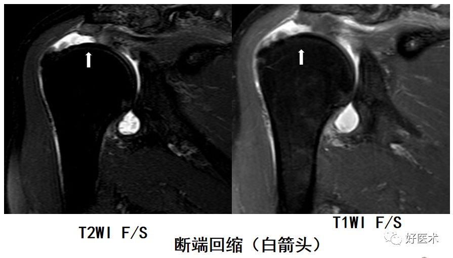 肩关节损伤的影像学诊断-37