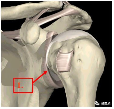 肩关节损伤的影像学诊断-4