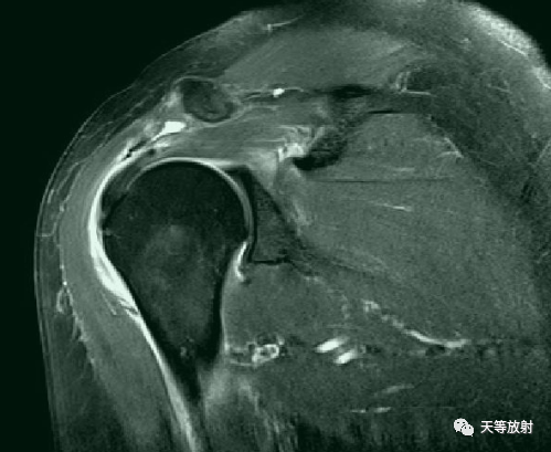 肩关节损伤的影像学诊断-33
