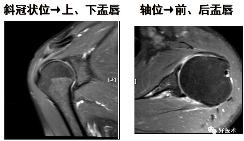 肩关节损伤的影像学诊断-42