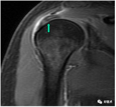 肩关节损伤的影像学诊断-31