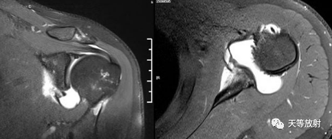 肩关节损伤的影像学诊断-49