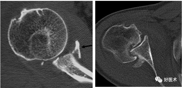肩关节损伤的影像学诊断-22