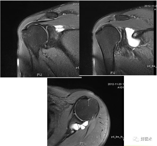 肩关节损伤的影像学诊断-44