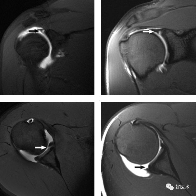 肩关节损伤的影像学诊断-27