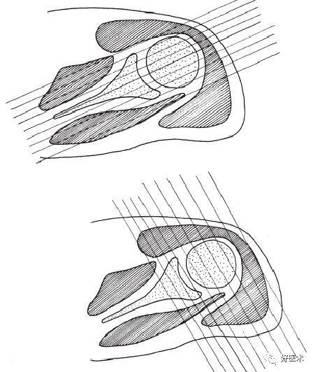 肩关节损伤的影像学诊断-26