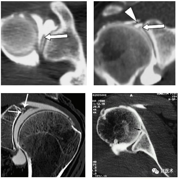 肩关节损伤的影像学诊断-25
