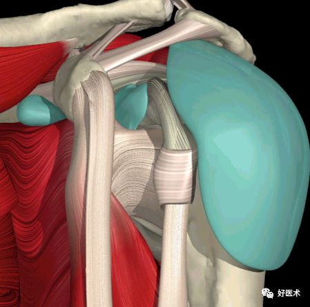 肩关节损伤的影像学诊断-6