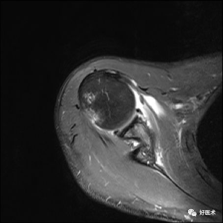 肩关节损伤的影像学诊断-53