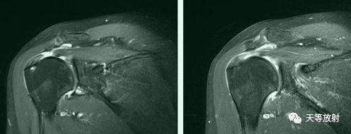 肩关节损伤的影像学诊断-34