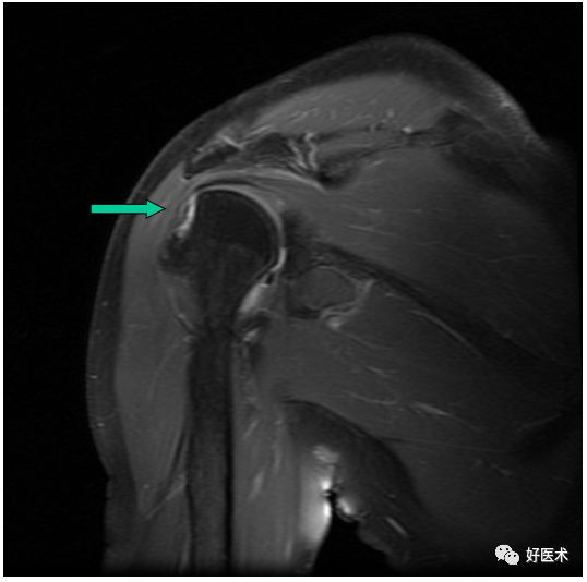 肩关节损伤的影像学诊断-58