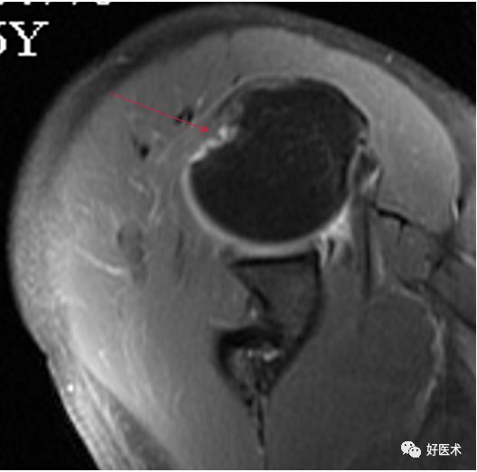 肩关节损伤的影像学诊断-57